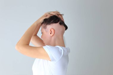 Genç bir kızda gerçek bir alopecia areata. Kel kafalı bir insan..