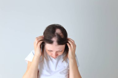 Genç bir kızda gerçek bir alopecia areata. Kel kafalı bir insan..