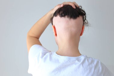Genç bir kızda gerçek bir alopecia areata. Kel kafalı bir insan..