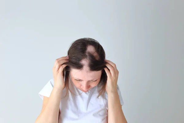 Uma verdadeira alopecia areata numa rapariga. Uma cabeça careca em uma pessoa . — Fotografia de Stock