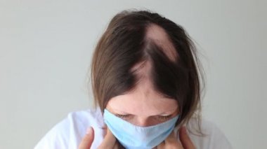 Genç bir kızda gerçek bir alopecia areata. Kel kafalı bir insan..
