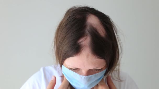 Echte Alopecia areata bei einem jungen Mädchen. Eine Glatze in einer Person. — Stockvideo