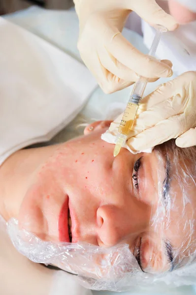 Mezoterapi enjeksiyon yüz içine.