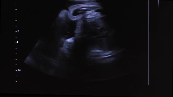 Gambar bayi yang belum lahir di dalam rahim pada layar USG — Stok Video