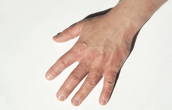 close-up of a hand with a red rash and eczema, fingers spread ap