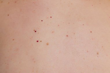 Ciltte birçok farklı benler