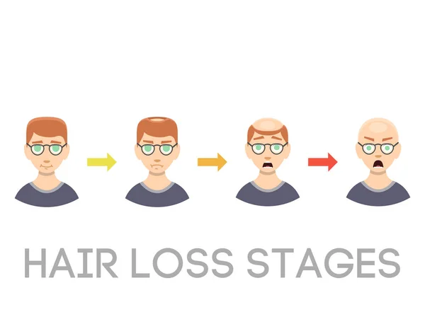 Informações gráfico de estágios de perda de cabelo tipos de calvície ilustrada no vetor de cabeça masculino . —  Vetores de Stock