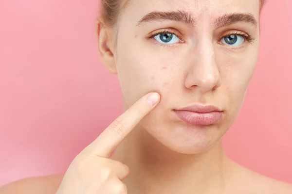 Retrato Menina Com Rosto Chateado Mostra Dedo Pele Problema Acne — Fotografia de Stock