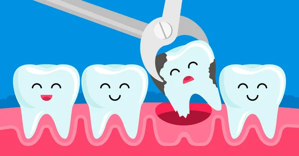 El diente con caries dental se extrae con pinzas en la cavidad oral. concepto de odontología infantil . — Vector de stock