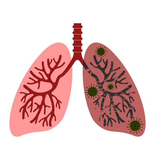 Людські легені страждають від пневмонії короновірусу в Китаї.. — стоковий вектор