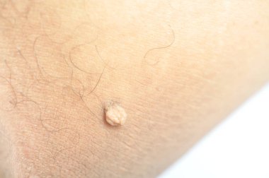 Pedunculated Mass deri etiketi ya da akrokondon ya da yumuşak fibroma. Papilloma, erkek vücudunda baldıra doğru büyük bir darbe almış.