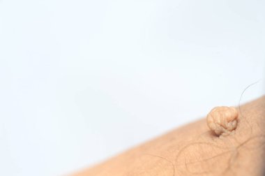 Pedunculated Mass deri etiketi ya da akrokondon ya da yumuşak fibroma. Papilloma, erkek vücudunda baldıra doğru büyük bir darbe almış.