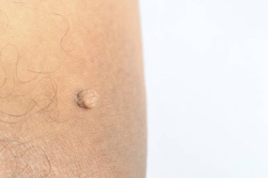 Pedunculated Mass deri etiketi ya da akrokondon ya da yumuşak fibroma. Papilloma, erkek vücudunda baldıra doğru büyük bir darbe almış.