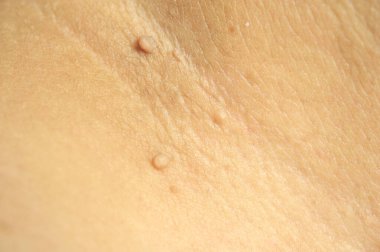 Pedunculated Mass deri etiketi ya da akrokondon ya da yumuşak fibroma. Papilloma, erkek vücudunda baldıra doğru büyük bir darbe almış.