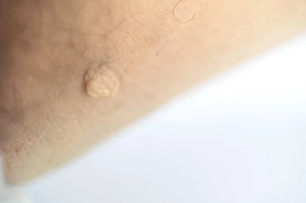 Pedunculated Mass skin tag or acrochondon or soft fibroma. Papilloma bump on male body macro shot on the Thigh