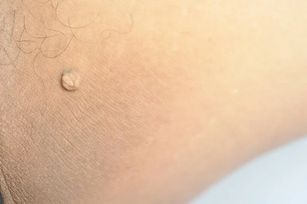 Pedunculated Mass skin tag or acrochondon or soft fibroma. Papilloma bump on male body macro shot on the Thigh — Stock Photo, Image