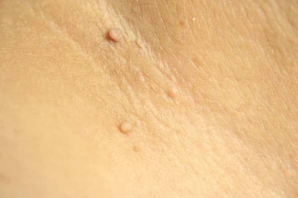 Pedunculated Mass skin tag or acrochondon or soft fibroma. Papilloma bump on male body macro shot on the Thigh — Stock Photo, Image