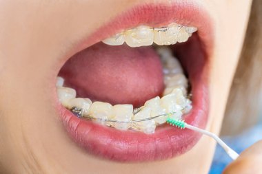 Diş ipi çubuğuyla dişlerini temizleyen ve diş sağlığı için diş teli takan bir kadının yakın plan fotoğrafı..