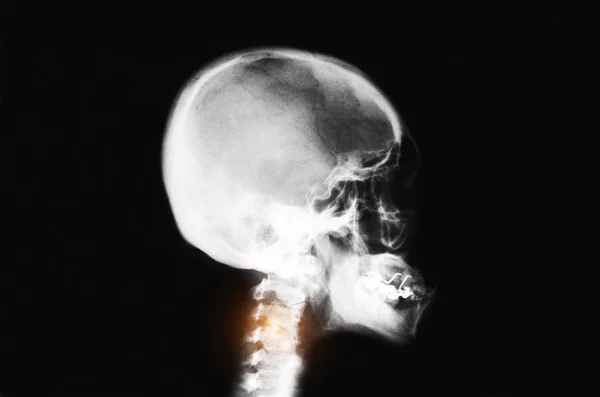 Skull Film Ray Ray Image Film Detail Neck Red Zone — Stock Photo, Image