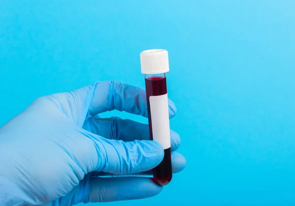 Δείγμα αίματος in vitro με το χέρι με το γάντι — Φωτογραφία Αρχείου