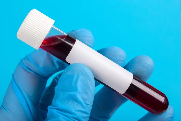 Amostra de sangue in vitro para a mão em luva — Fotografia de Stock