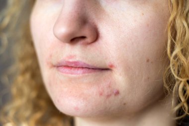 Sorunlu ciltli güzel bir kadının portresi. Cilt bakımı kavramı.