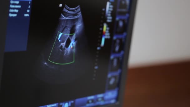 Exame ultra-sonográfico do abdómen. Monitor de tela extrema close up . — Vídeo de Stock