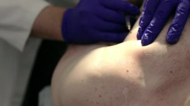 Köstebek cerrahi doğum lekesi kaldırma önce etrafında lokal anestezi enjekte doktor