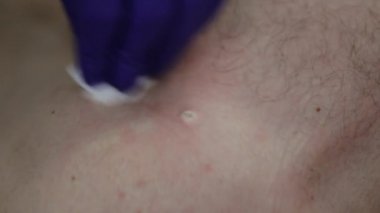 Doktor cerrahi prosedürde mol kaldırma.