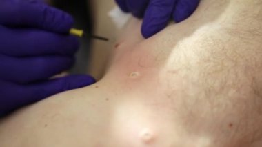 Doktor cerrahi prosedürde mol kaldırma.