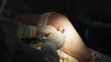 Kadın bacak üstünde işlem. Varis yakın çekim cerrahi