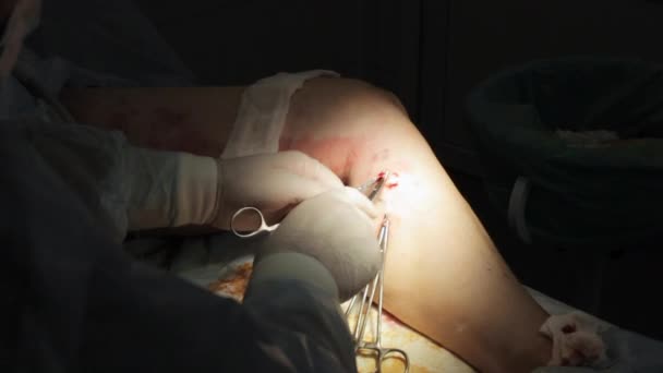 Operazione alla gamba femminile. Chirurgia delle vene varicose primo piano — Video Stock