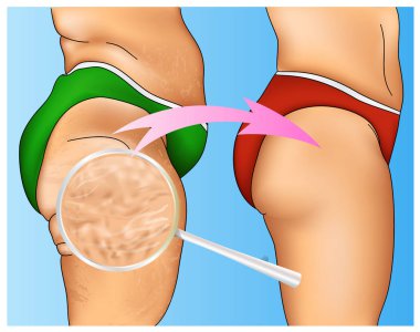 Colorful illustration of woman cellulite with arrow designation and magnifying glass clipart
