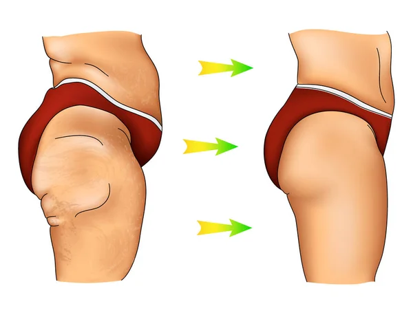 Ilustración Colorida Celulitis Femenina Con Designación Flecha — Vector de stock