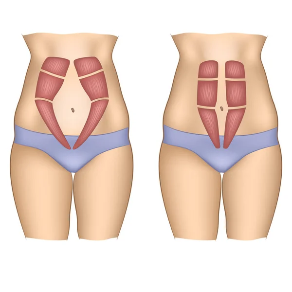 Músculos Abdominais Uma Barriga Mulher —  Vetores de Stock