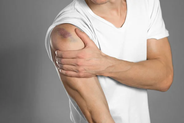 The bruise on the shoulder. Shoulder pain. The man holds his han — Stock Photo, Image