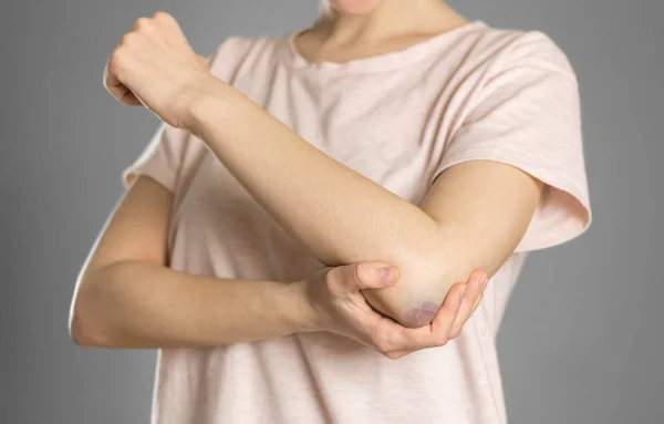 The bruise on my elbow. Pain in the elbow. The woman holds her h — Stock Photo, Image