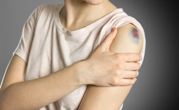 The bruise on his shoulder. Shoulder pain. The woman holds her h — Stock Photo, Image