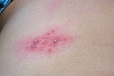 blisters caused by shingles on skin, herpes zoster clipart