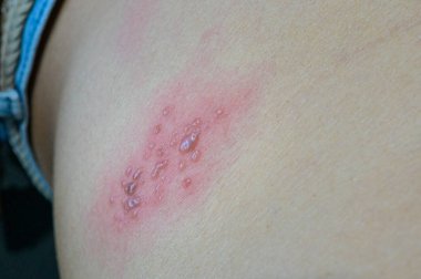 Kabarcıklar cildindeki kiremitlerden kaynaklanıyor, herpes zoster