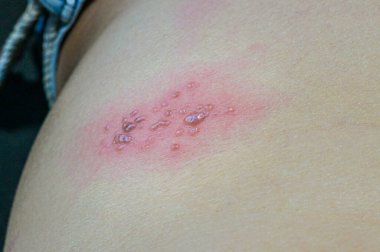 Kabarcıklar cildindeki kiremitlerden kaynaklanıyor, herpes zoster