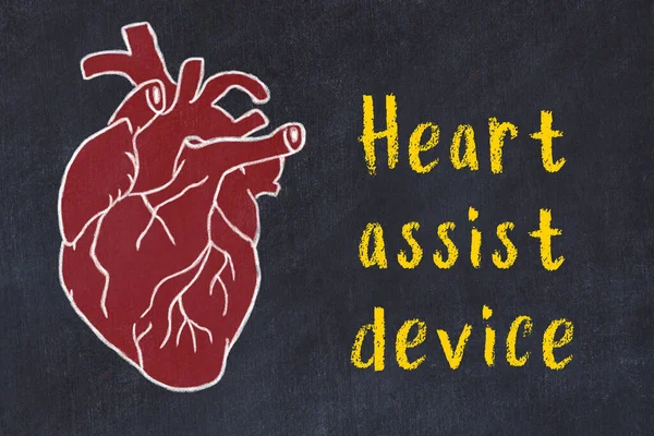 Concept of learning cardiovascular system. Chalk drawing of human heart and inscription Heart assist device