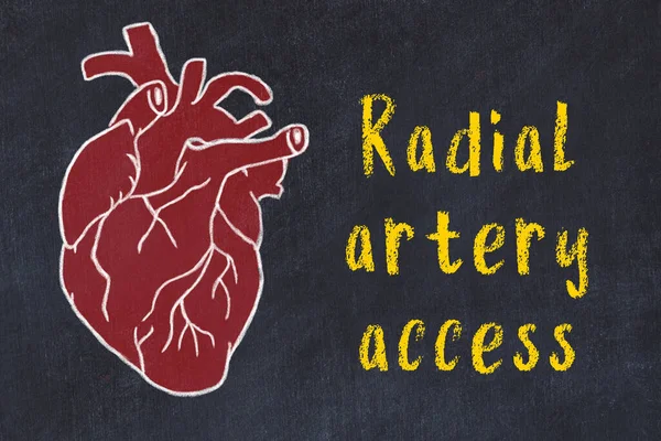 Μαθαίνω την έννοια του καρδιολογικού συστήματος. Σχέδιο κιμωλίας ανθρώπινης καρδιάς και επιγραφή Ακτινική πρόσβαση αρτηρίας — Φωτογραφία Αρχείου