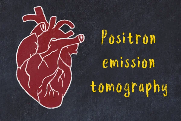 Schizzo in gesso del cuore umano su dec nero e iscrizione Tomografia a emissione di positroni — Foto Stock