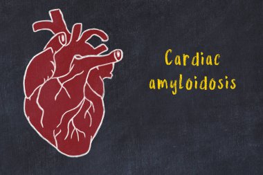 Siyah masadaki insan kalbinin tebeşir çizimi ve kardiyak amiloidoz.
