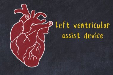 İnsan kalbinin tebeşir çizimi siyah masa ve yazıt üzerinde Sol ventriküler yardımcı aygıt
