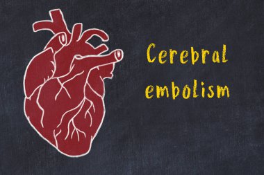Siyah masadaki insan kalbinin tebeşir çizimi ve beyin embolisi.