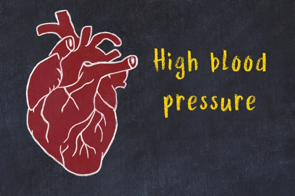 Koncepce učení kardiovaskulárního systému. Kreslení lidského srdce křídou a nápis Vysoký krevní tlak — Stock fotografie