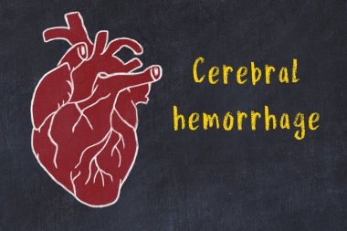 Kardiyo sistemi konseptini öğreniyorum. İnsan kalbinin tebeşir çizimi ve yazılı beyin kanaması.