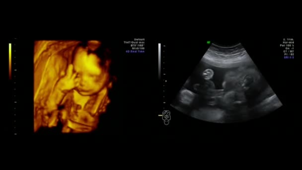 Imágenes de ecografías fetales — Vídeo de stock